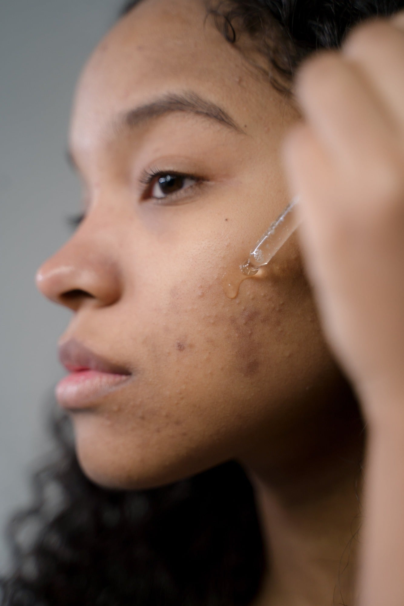 Macchie post acne: come prevenirle e come trattarle