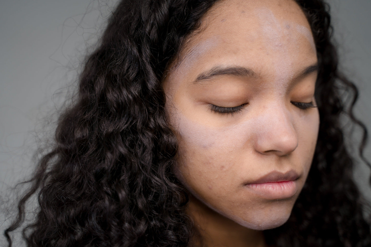 Quanto dura l'acne ormonale: considerazioni e consigli pratici